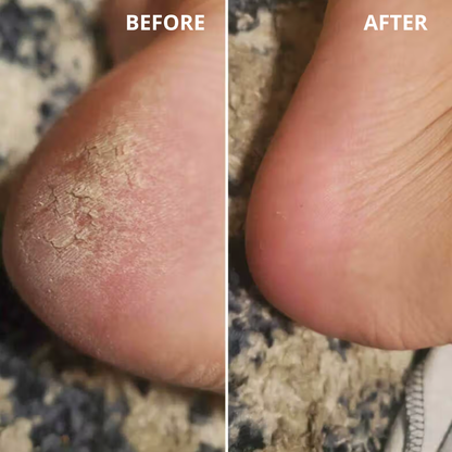 Heavy-Duty Callus Remover