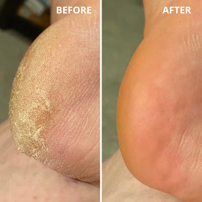 Heavy-Duty Callus Remover