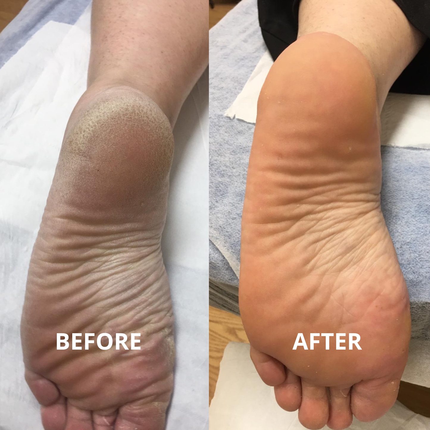Footstick for Dry & Callused Heels